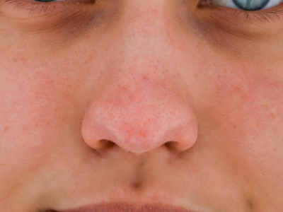 nosies pertvaros iskrypimas