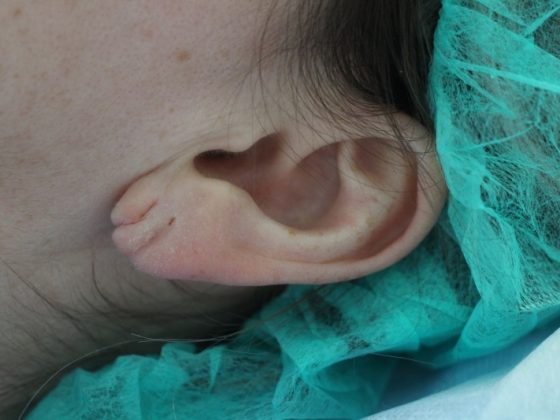 Otoplastika / ausų plastika: Pacientė #4532, nuotrauka prieš